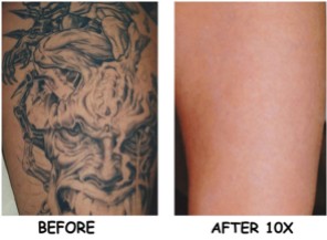 laser-tattoo-removal-sd